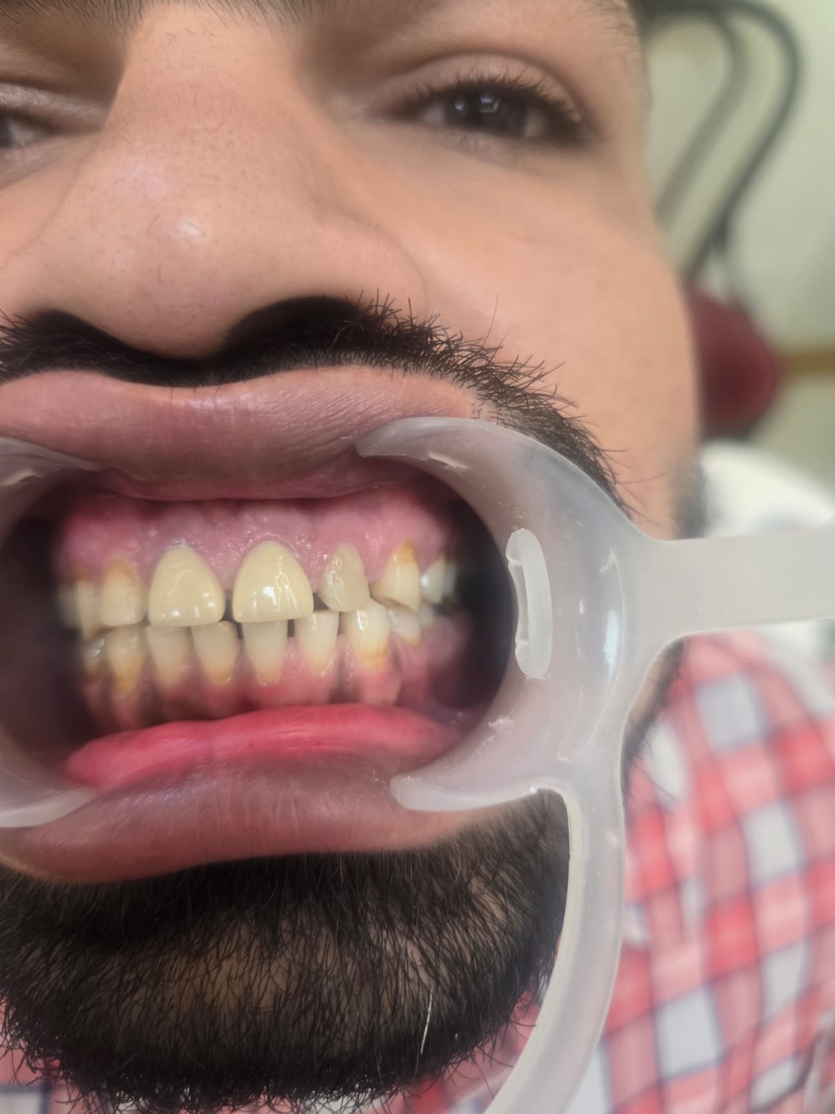 Mukhija Dental Clinic - Treatment photo 6
