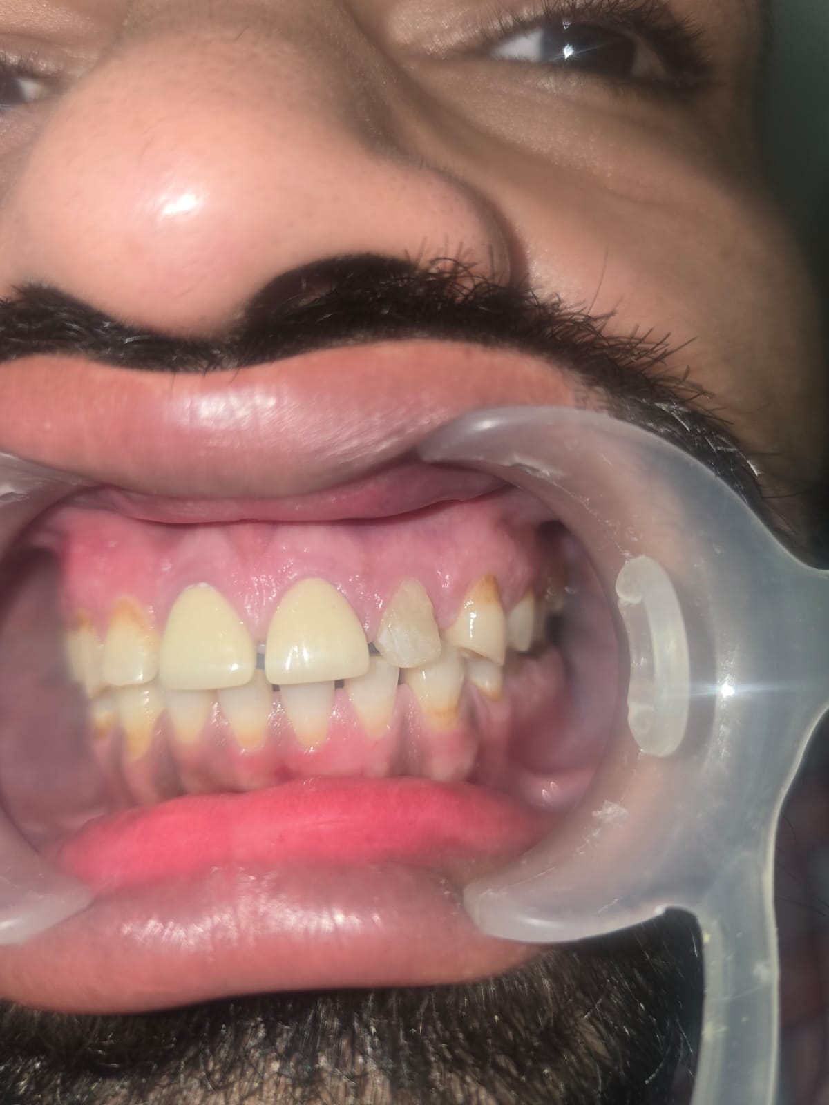 Mukhija Dental Clinic - Treatment photo 7