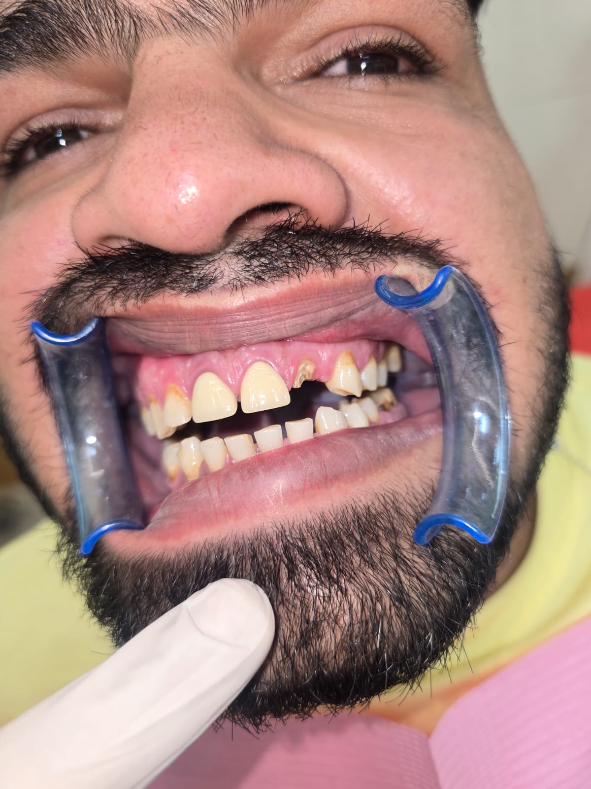 Dental Implants in Sonipat