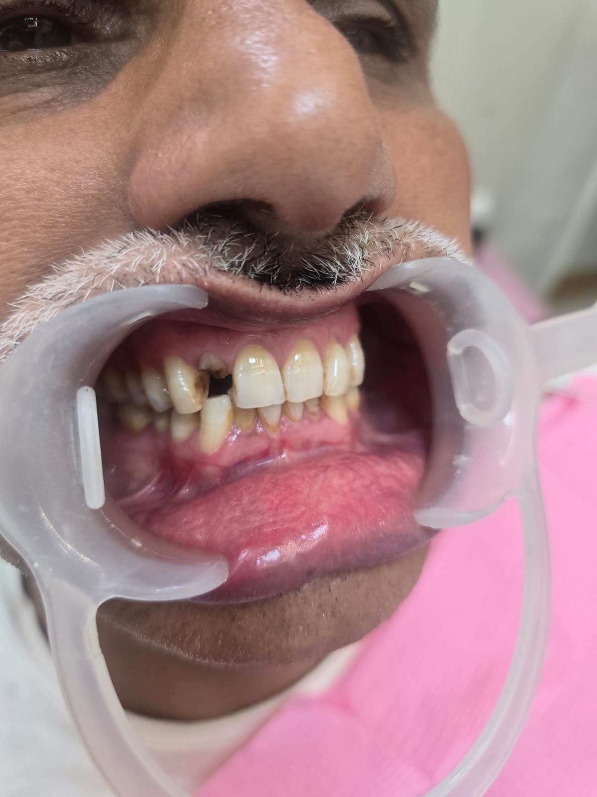 Mukhija Dental Clinic - Treatment photo 11