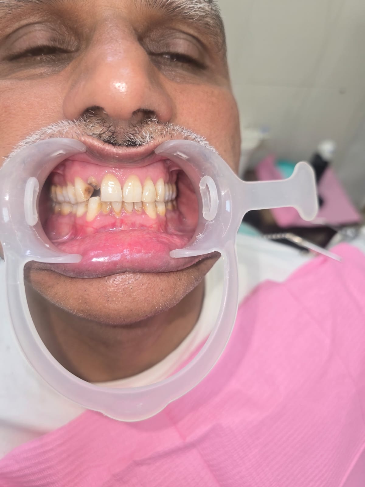 Mukhija Dental Clinic - Treatment photo 12