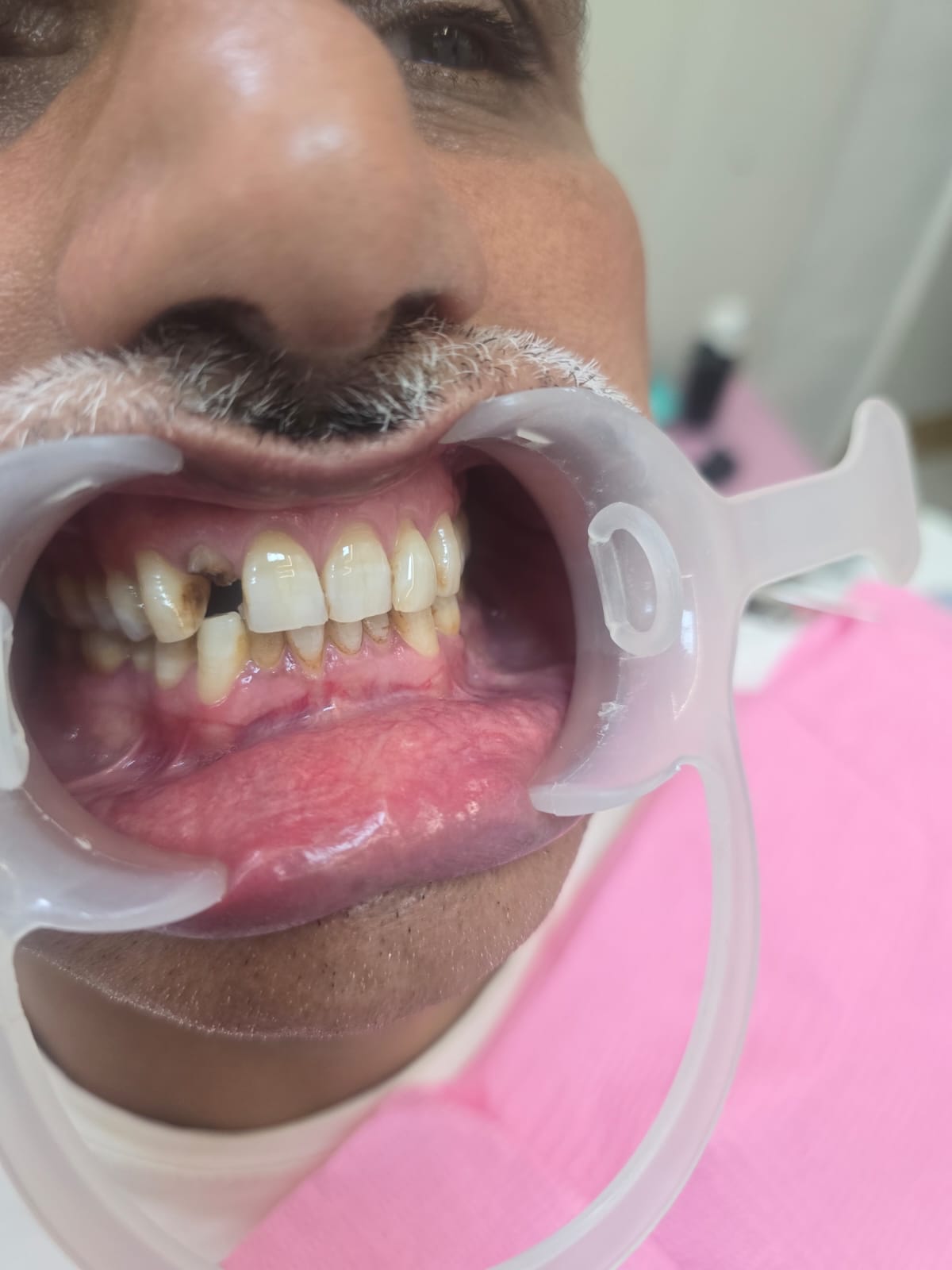 Multiple Teeth Implants