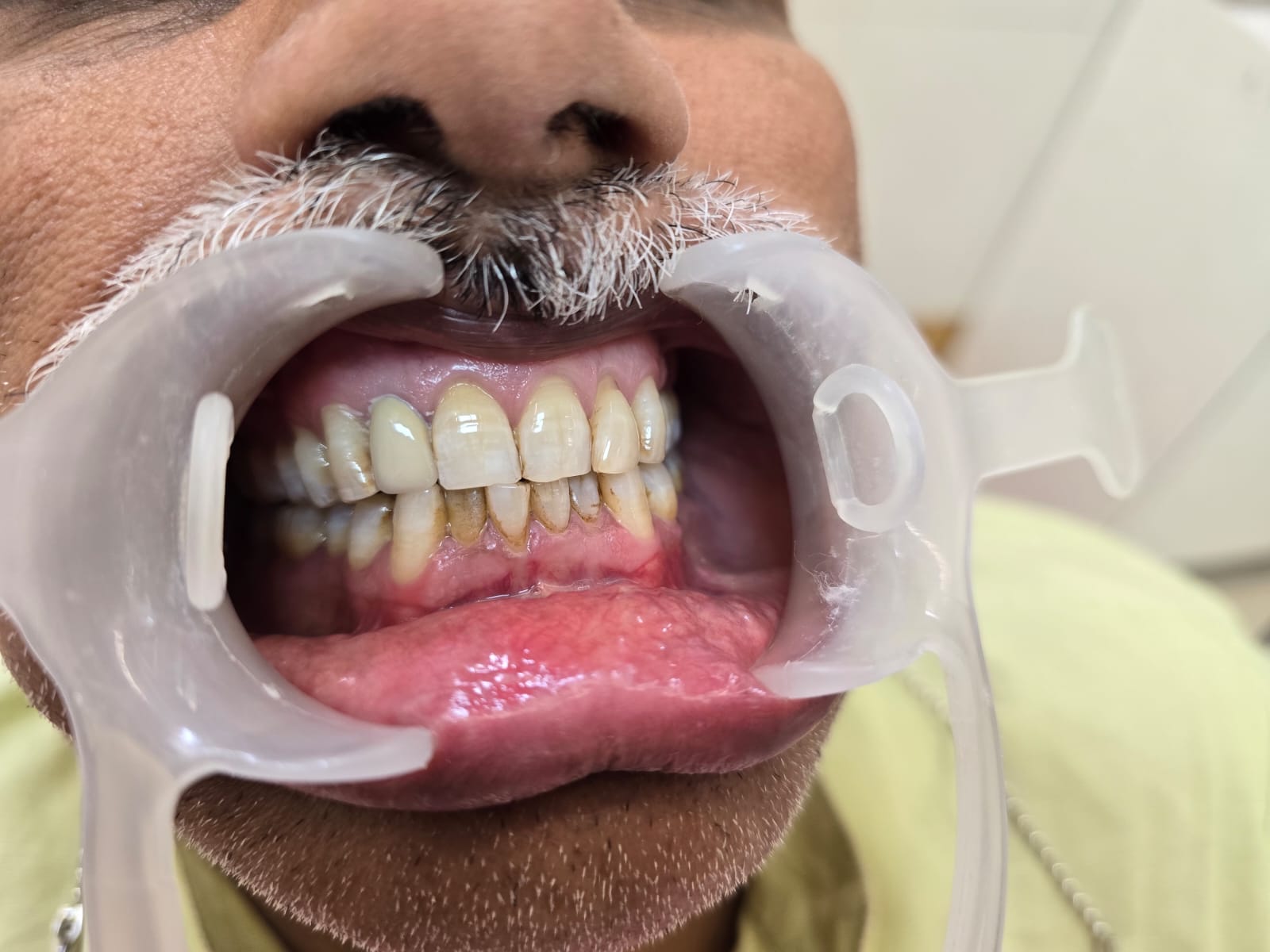 Teeth Cleaning