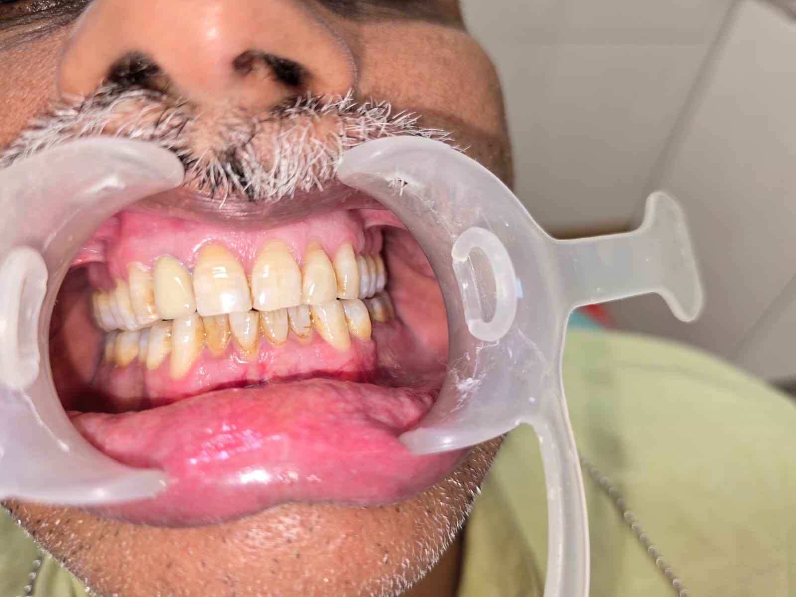 Mukhija Dental Clinic - Treatment photo 16