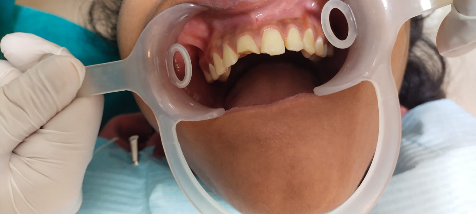 Smile Makeover β before treatment