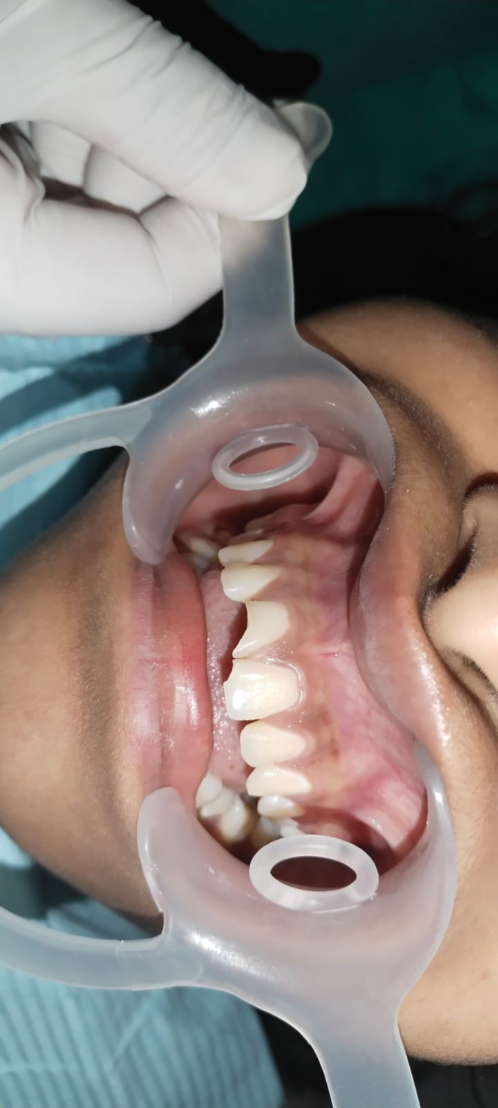 Smile Makeover β after treatment