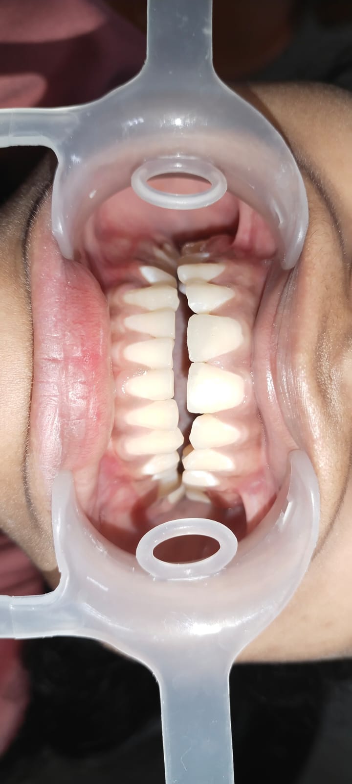 Mukhija Dental Clinic - Treatment photo 20