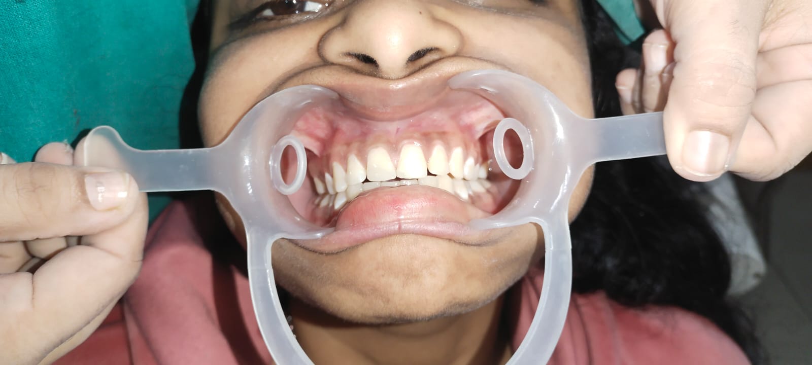 Orthodontics Treatment