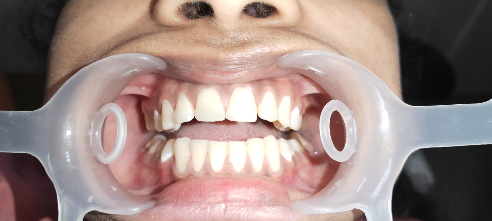 Mukhija Dental Clinic - Treatment photo 22